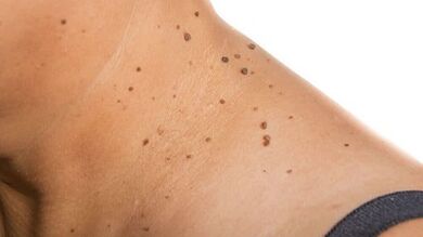 Comment se débarrasser de la papillome autour de votre cou