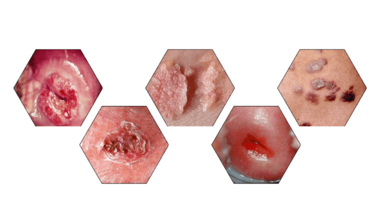 Pourquoi les papillomes sont-ils dangereux