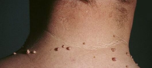 comment se débarrasser des papillomes