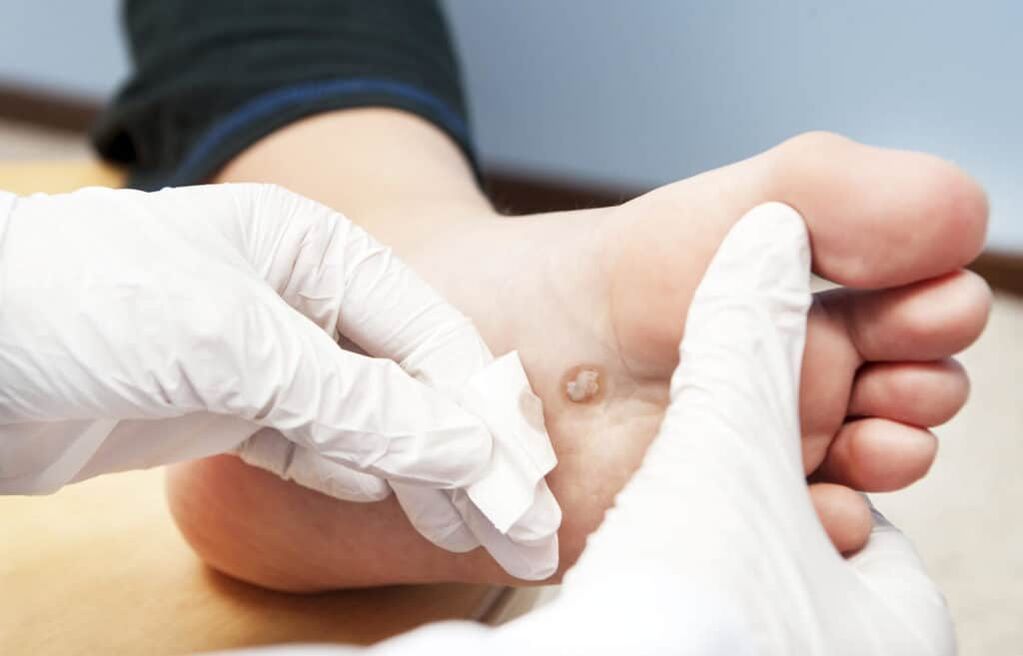 Pourquoi les verrues apparaissent-elles sur le corps