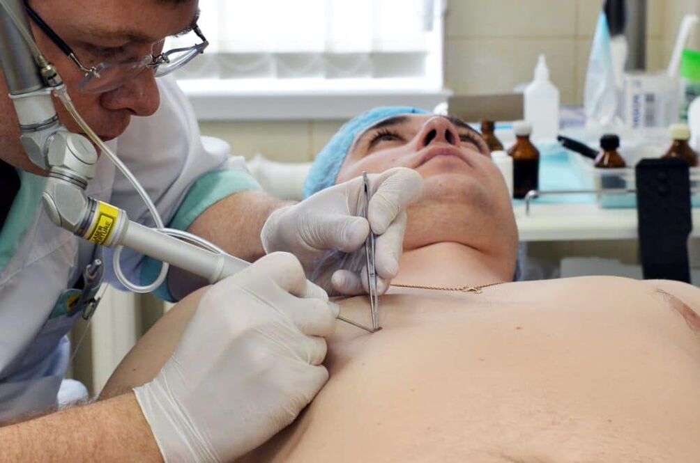 comment se débarrasser des verrues sur le corps