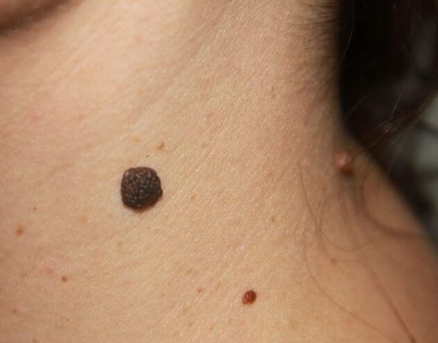 Papillomes plats sur le cou