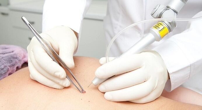 Élimination au laser des papillomes avec des virus du papillome