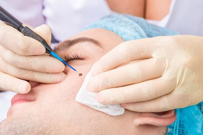 Élimination des papillomes du visage dus au virus du papillome humain